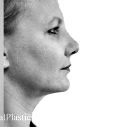 Houston Neck Lifts Before & Afters