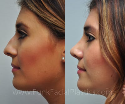 The Single Strategy To Use For Best Rhinoplasty Surgeon Austin Tx