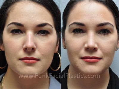3 Simple Techniques For Top Nose Surgery Austin