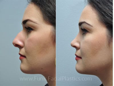 The Single Strategy To Use For Cosmetic Nose Surgeon Austin Tx