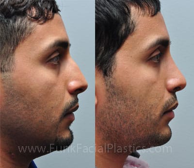 Male Rhinoplasty - Nose Jobs for Men | Funk Facial Plastic Surgery