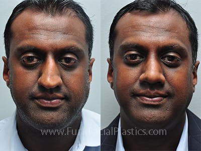 Male Rhinoplasty - Nose Jobs for Men | Funk Facial Plastic Surgery