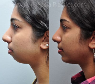 This Houston chin implant patient had a severely recessed chin and created ...
