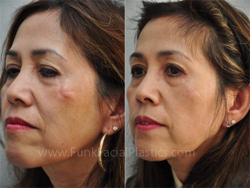Facial Scar Revision Facial Surgery