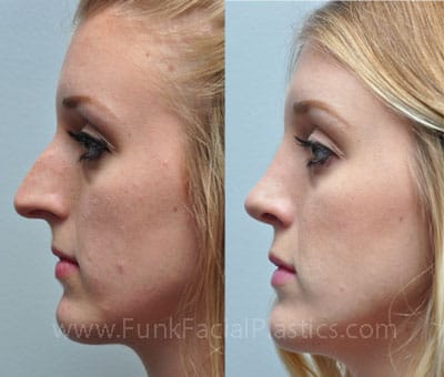 nose job for wide nose cost