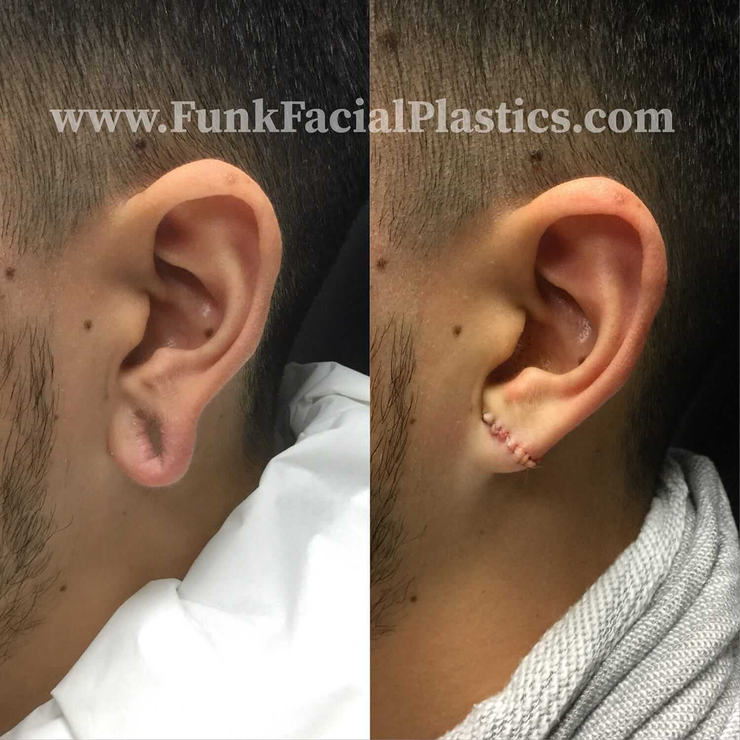 Ear Lobe Repair Surgery for stretched earring holes 